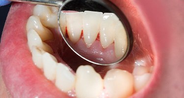 a dentist using a mirror to examine teeth