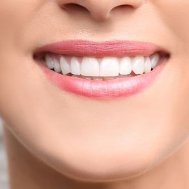 Closeup of woman with cosmetic dental bonding smiling