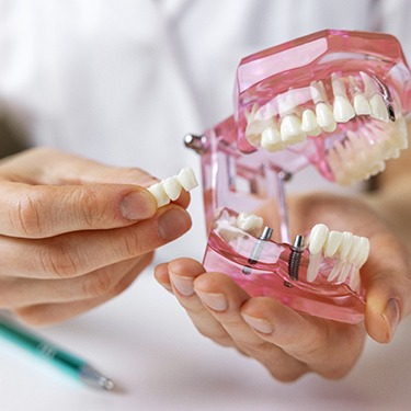 model of a mouth having a bridge placed on it