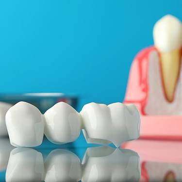 dental bridge lying on a table