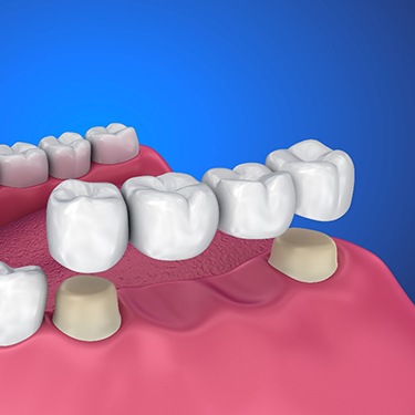 3-D render of a dental bridge