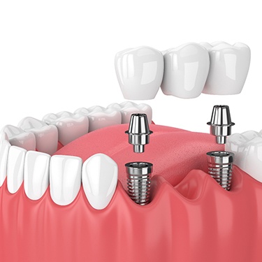 3-D render of an implant bridge