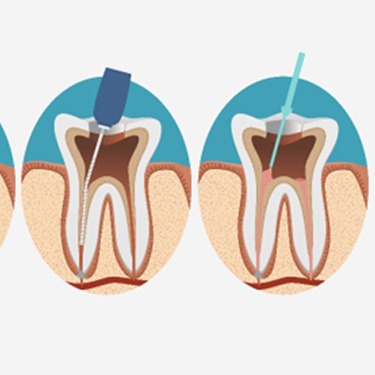 illustration of root canal therapy process 