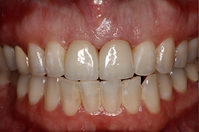 Healthy smile after cosmetic dentistry