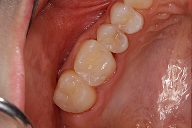 Healthy repaired tooth after cosmetic dentistry