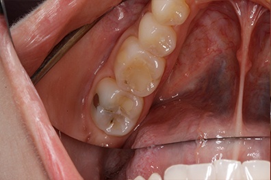 Decayed back tooth before restorative dentistry