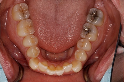 Back two teeth with metal fillings
