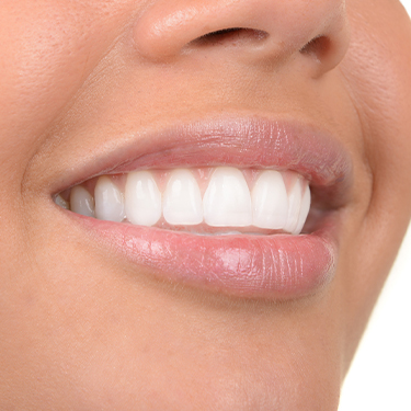 Closeup of smile with tooth-colored filling