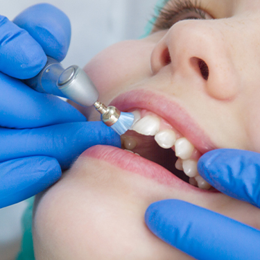 Patient receiving professional fluoride treatment