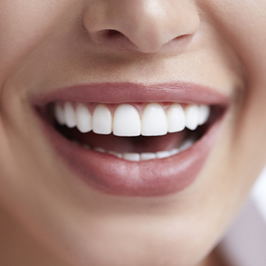 Closeup of smile with cosmetic dental bonding
