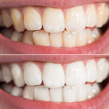 Closeup of smile before and after teeth whitening