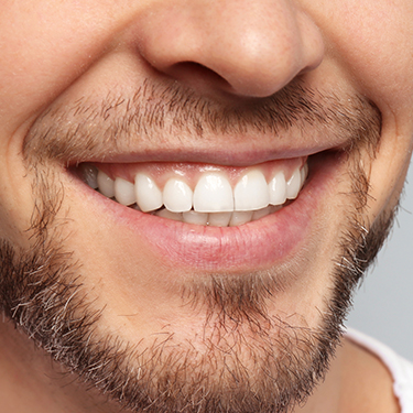 Closeup of smile after gum recontouring