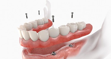 3D render of implant dentures