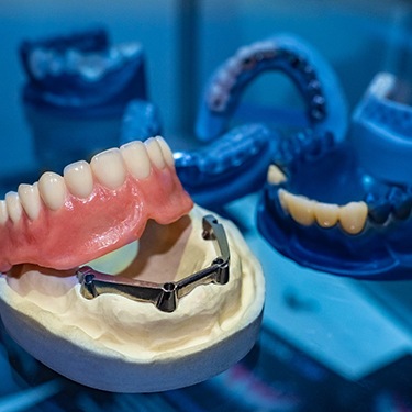implant dentures on a plaster mold