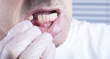 A closeup of a mouth with missing teeth