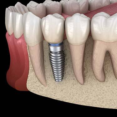 dental implant in Guilderland, NY replacing a single missing tooth 