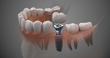 single dental implant with a crown 