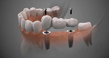 two dental implants supporting a dental bridge 