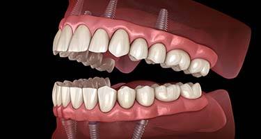two full dentures supported by multiple dental implants 