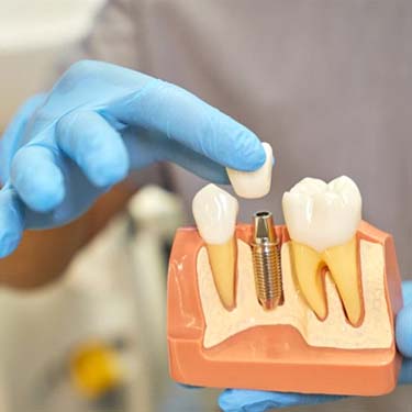 implant dentist in Guilderland placing a crown onto a model of a dental implant