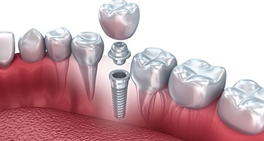 Model showing parts of a dental implant