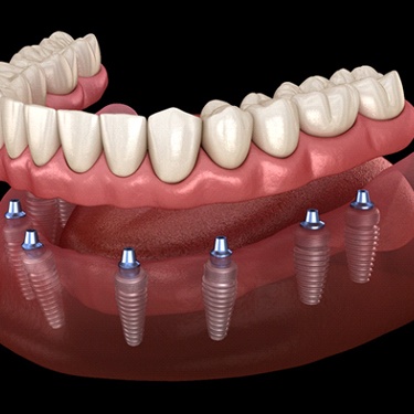 Render of implant dentures in Guilderland, NY for lower arch