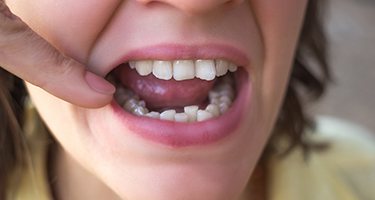 Nose-to-chin view of someone pointing to their crowded teeth