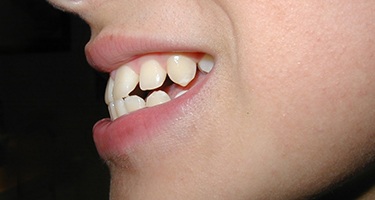 Nose-to-chin profile view of someone with an open bite
