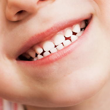 Child's healthy smile after dental implants