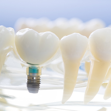 Implant supported dental crown model