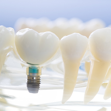 Implant supported dental crown model