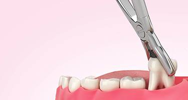 3D illustration of tooth extraction 