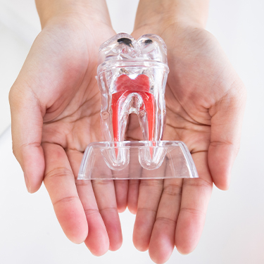 Model of root canal treated tooth
