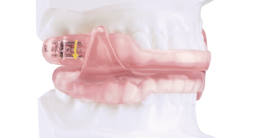 Dorsal sleep apnea appliance