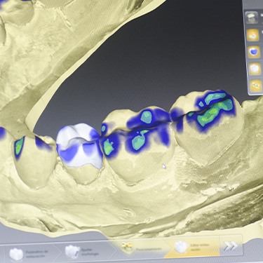 Digital impressions of smile before dental restoration