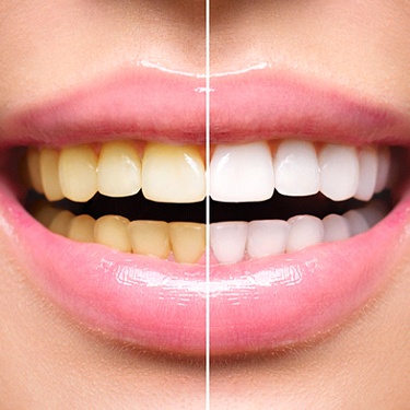 Close up of before and after teeth whitening