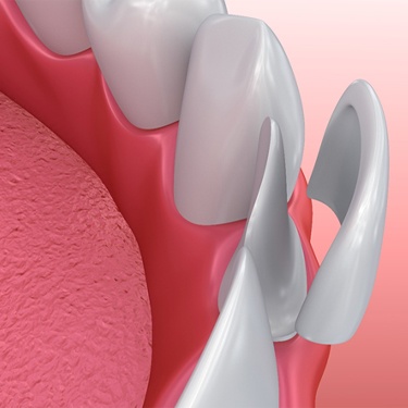 3D illustration of a single porcelain veneer