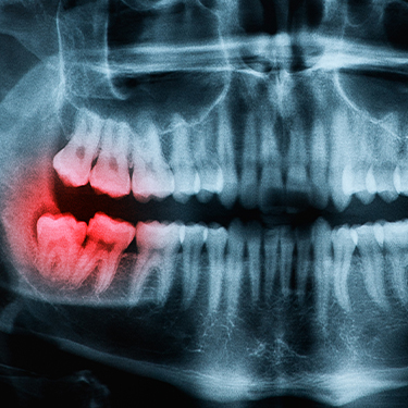 X-ray of impacted wisdom tooth