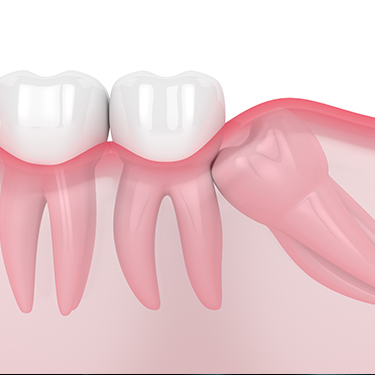 3 D rendering of impacted wisdom tooth