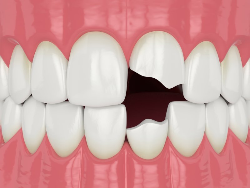 A 3D illustration of a chipped tooth