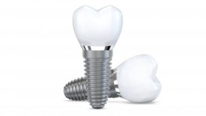 dental implants 3D illustration 