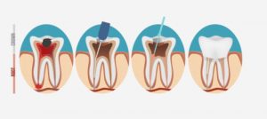 illustration of root canal process