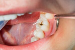 Mouth open showing cavity.